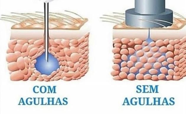 hialuronic pen tratamento sem aghulas