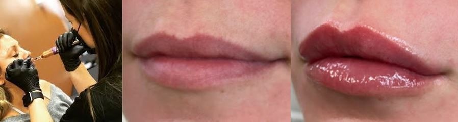 preenchimento labial antes e depois