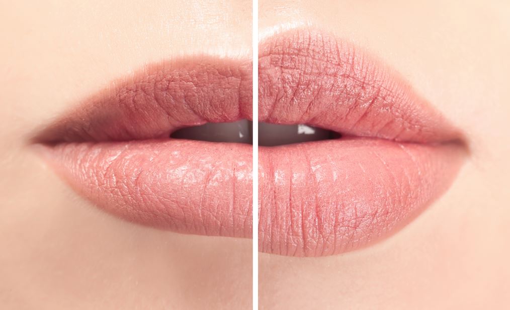 preenchimento labial antes e depois resultados